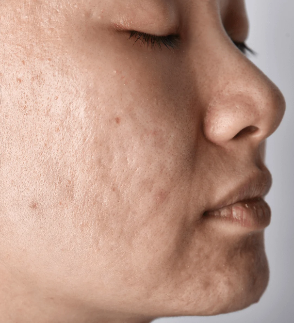Acne Scarring Med Spa In Tulsa Ok Tulsa Hills Cosmetic And Laser